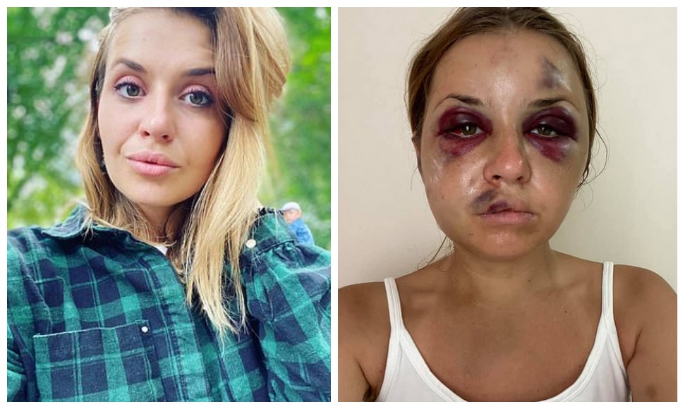 A apresentadora de TV Anastasia Lugova antes e depois das agressões sofridas por ela (Foto: Facebook)