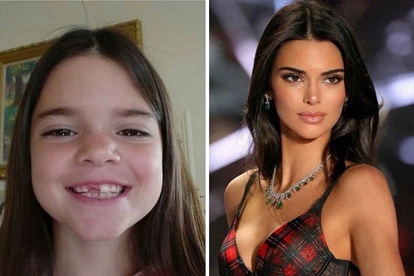 A modelo Kendall Jenner: Antes e depois (Foto: Instagram)