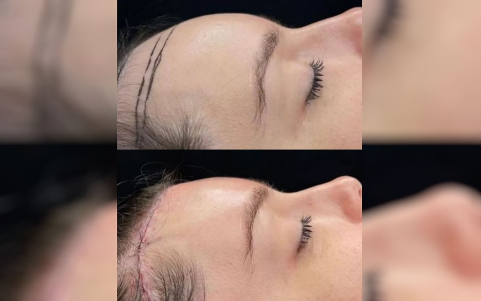 Ex-BBB Thais Braz faz cirurgia para diminuir o tamanho da testa — Foto: Reprodução/Redes Sociais
