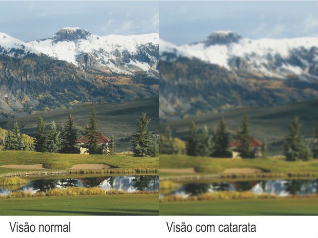 G1 Lentes Trifocais oferecem vis o plena e sem culos para quem