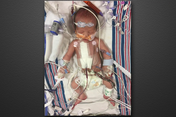 O filho recém-nascido do apresentador Jimmy Kimmel após passar por uma cirurgia no coração (Foto: Reprodução)