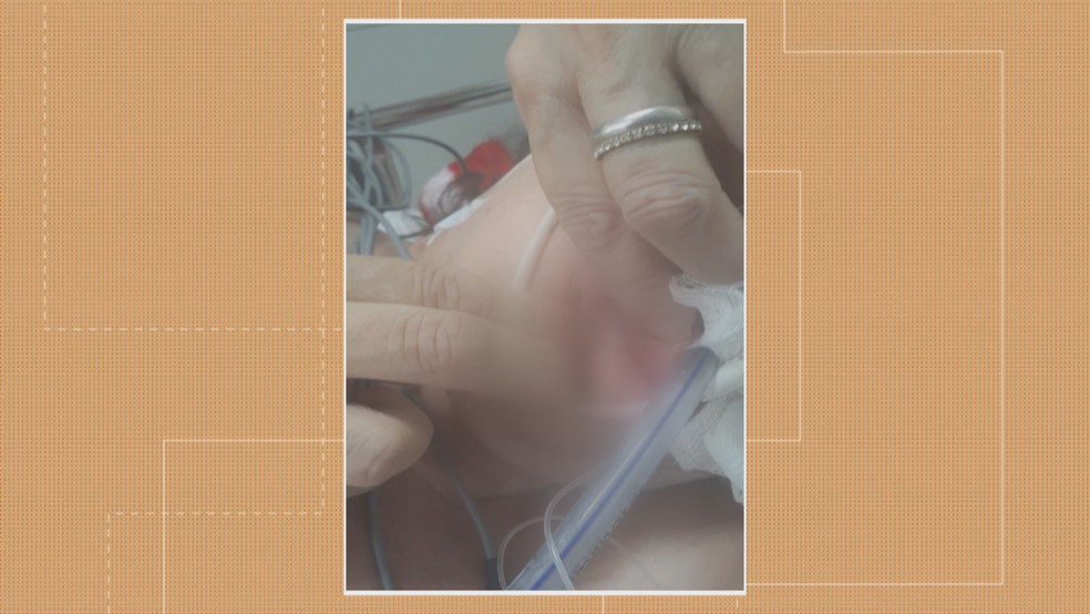 Larvas foram encontradas na boca de paciente do Hospital Universitário de Santa Maria — Foto: Reprodução