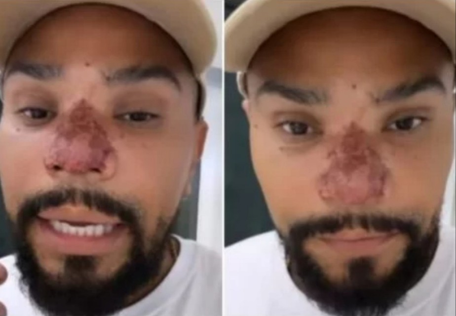 O cantor Naldo Benny passou por uma complicação após um procedimento estético que acabou necrosando parte de seu nariz