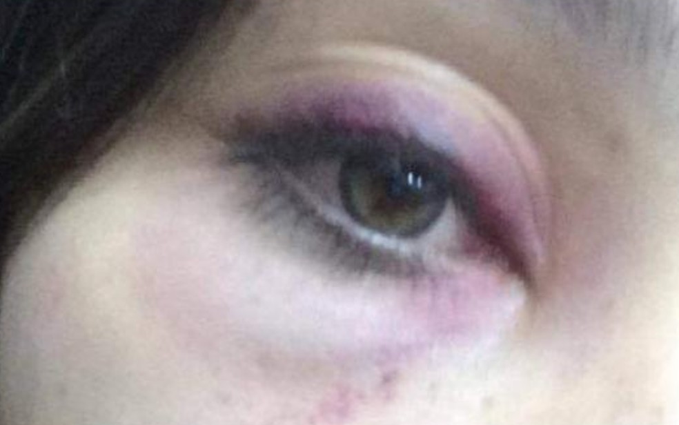 Thaynara Stefanny mostra hematoma de agressão sofrida por namorado, em Goiânia — Foto: Thaynara Stefanny/Arquivo Pessoal