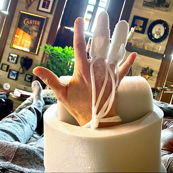 A mão do ator Neil Patrick Harris após ele passar por uma cirurgia (Foto: Instagram)