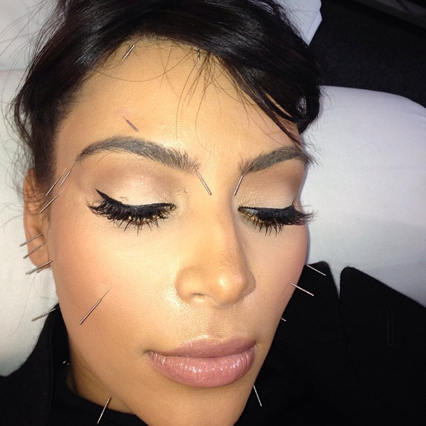 Kim Kardashian fazendo acupuntura (Foto: Instagram)