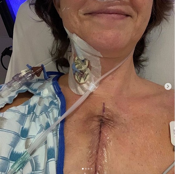A imagem compartilhada pela cantora Amy Grant mostrando a cicatriz em seu peito após passar por uma cirugia cardíaca (Foto: Instagram)
