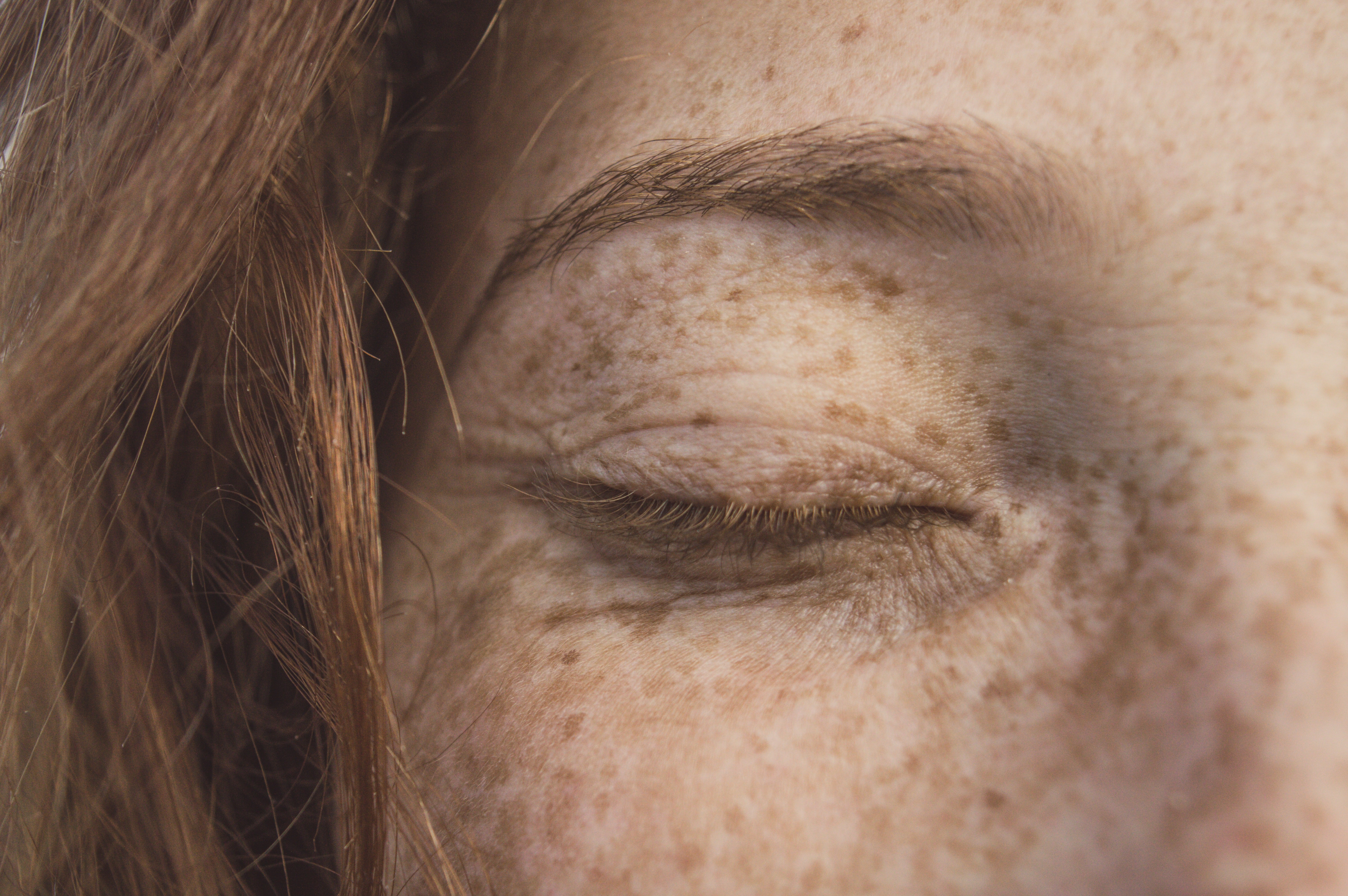 Câncer de pele: como diferenciar uma pinta de uma lesão mais grave? (Foto: Chermiti Mohamed/Unsplash)