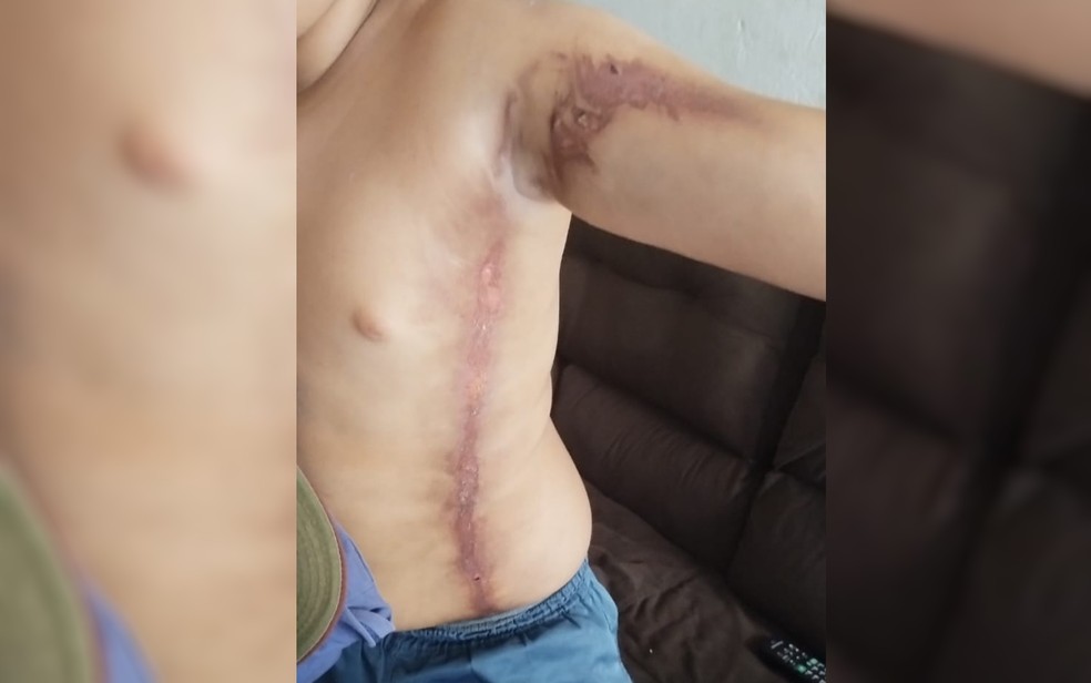 Edison Júlio, de 12 anos, ficou ferido após ser atingido por um raio em Montes Claros de Goiás — Foto: Arquivo Pessoal/Flávio Júlio