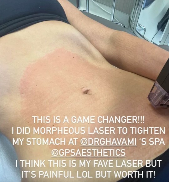 O post de Kim Kardashian divulgando um tratamento a laser na barriga (Foto: Instagram)