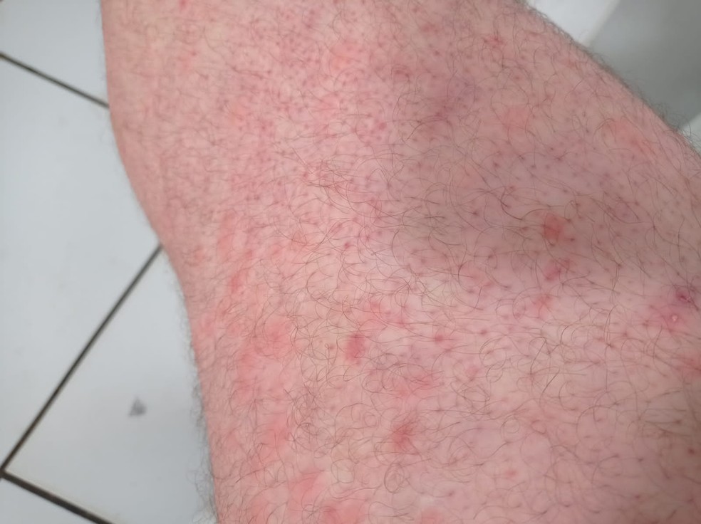 Irritação na pele é causada por cerdas de mariposa, segundo dermatologistas — Foto: Reprodução/WhatsApp