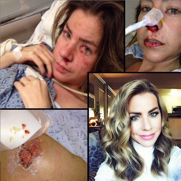 Uma montagem compartilhada pela modelo Jessica Landon mostrando o instante no qual ela foi levada para um hospital no auge de seu vício (Foto: Instagram)