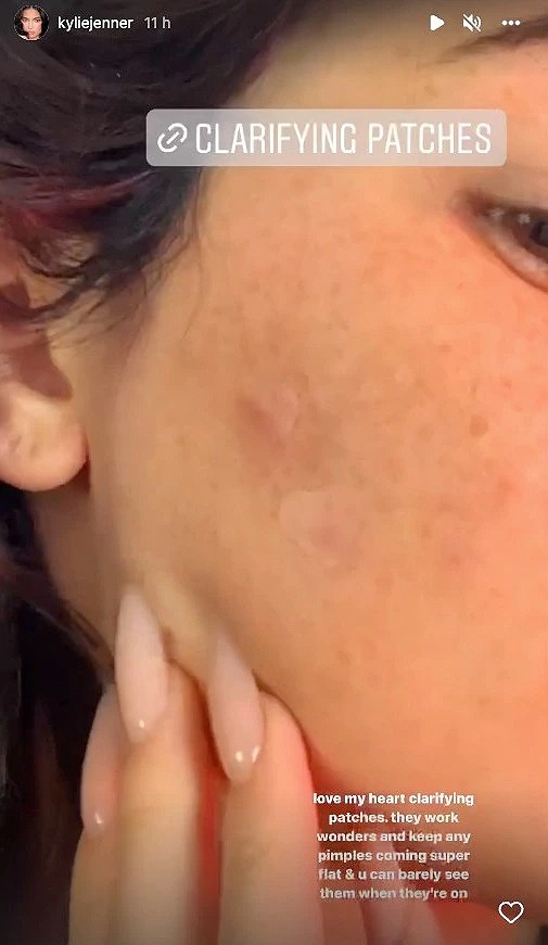 Kylie Jenner showed a pimple on her cheek in an Instagram post (Photo: reproduction / Instagram)