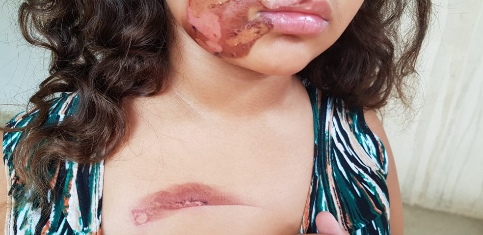 Menina foi queimada pela mãe por não conseguir fazer tarefa escolar em Olinda, segundo denúncias — Foto: Conselho Tutelar de Olinda/Divulgação