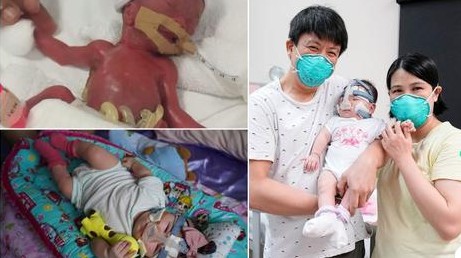 Bebê que nasceu com pouco mais de 200g deixou hospital após 13 meses de internação (Foto: Reprodução/Facebook/National University Hospital - NUH)
