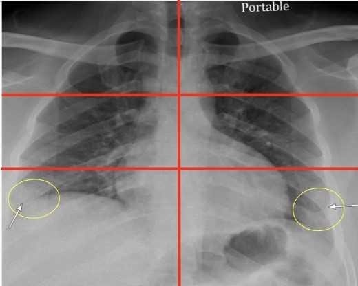 Raio-x pode indicar pacientes com maior risco de complicações por Covid-19. Acima: radiografia de um jovem de 23 anos cuja pontuação foi 2. (Foto: Mount Sinai Health System)