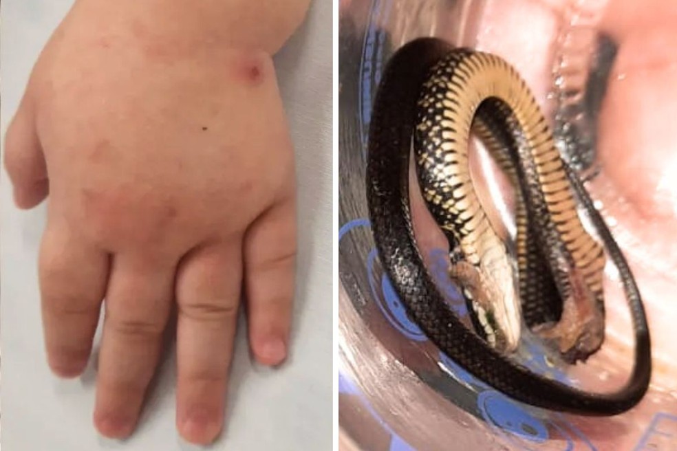 Menina foi mordida pela cobra dentro de casa, no litoral de São Paulo — Foto: Arquivo Pessoal