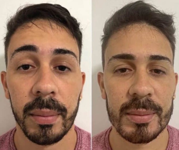 Antes e depois da harmonização de Carlinhos Maia (Foto: Reprodução/Instagram)