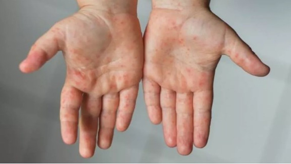 Manchas na pele são alguns dos sintomas da doença rara associada à Covid-19  — Foto:  Foto: Getty images via BBC