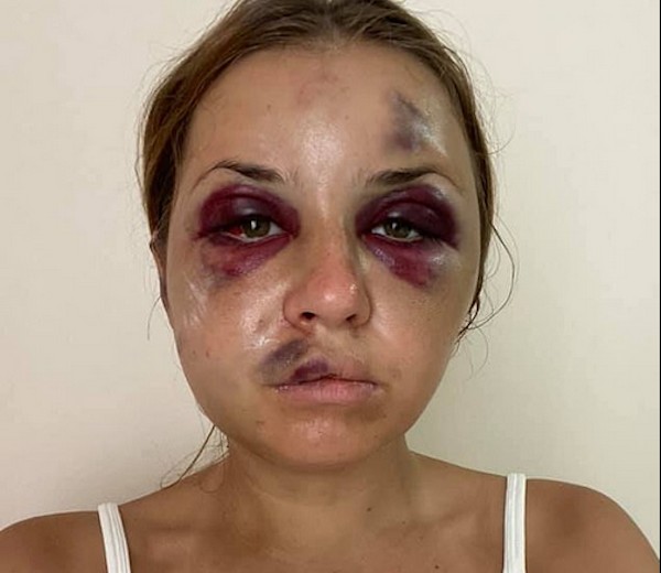 A apresentadora de TV ucraniana Anastasia Lugova com as lesões das agressões sofridas por ela (Foto: Facebook)