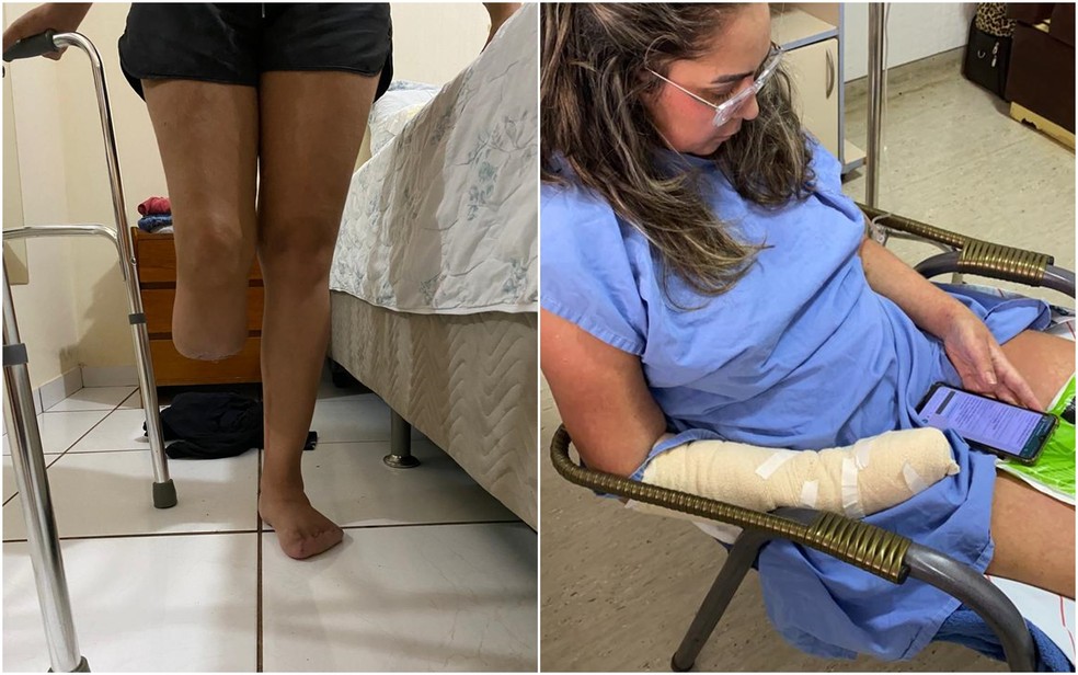 Indialma Antunes teve parte da perna e dedos amputados por causa de infeces aps lipo em Goinia, Gois  Foto: Indialma Antunes/Arquivo pessoal