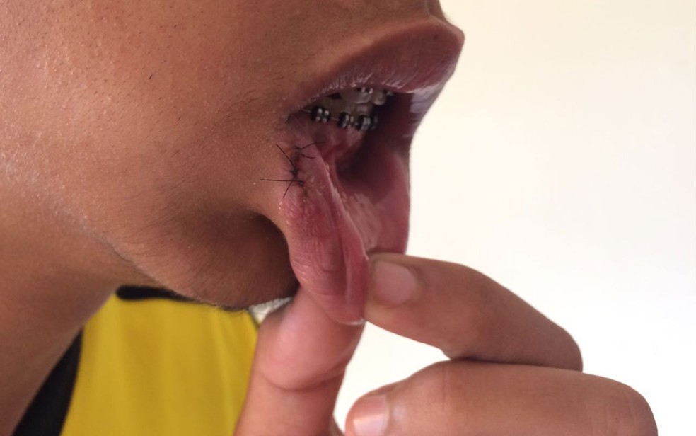 Rapaz vÃ­tima de agressÃ£o de PM na Zona Oeste de SÃ£o Paulo mostra lÃ¡bio ferido apÃ³s levar soco (Foto: Glauco AraÃºjo/G1)