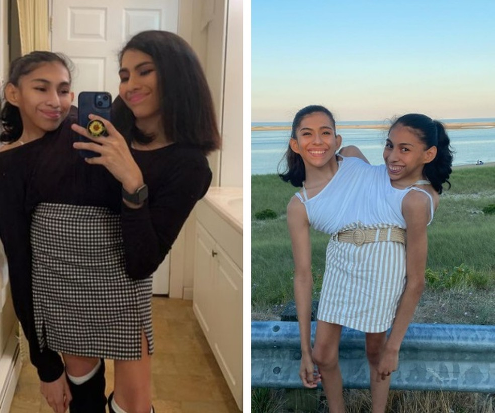 Gêmeas siamesas de 22 anos contam como é compartilhar a vida por tanto