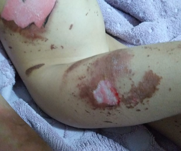 Após explosão do celular, criança tem queimadura de 2º grau  (Foto: Arquivo Pessoal )