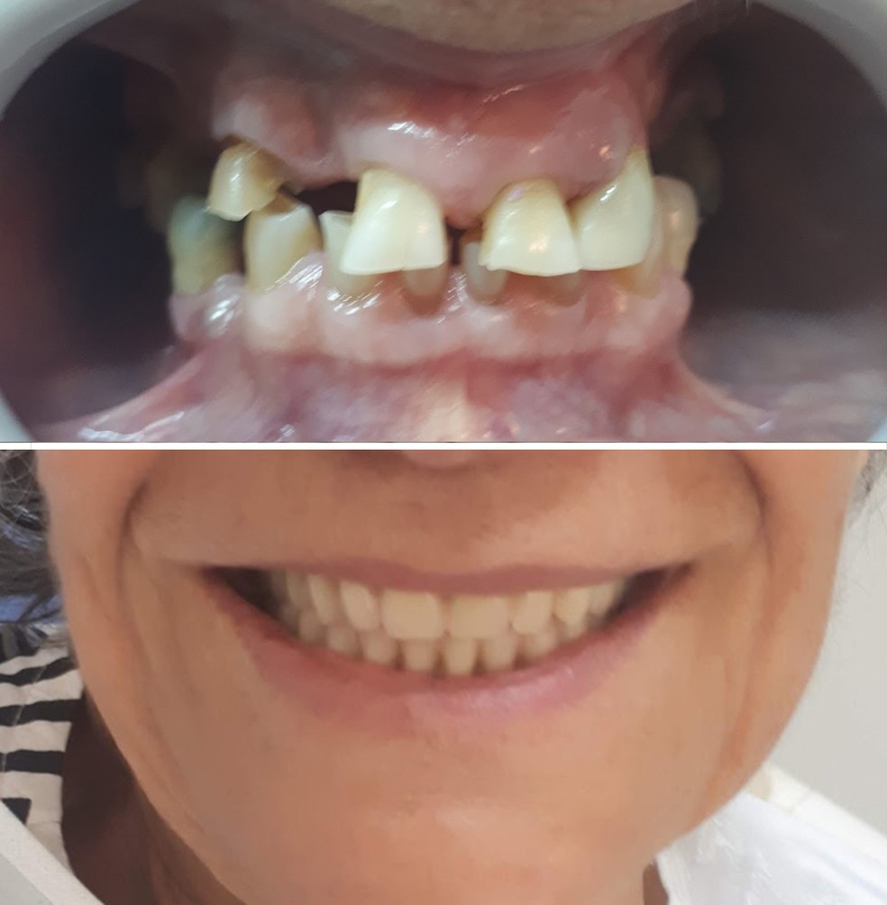 Implantes Dentarios Acessiveis Em Juiz De Fora Especial Publicitario Jf Implantes G1