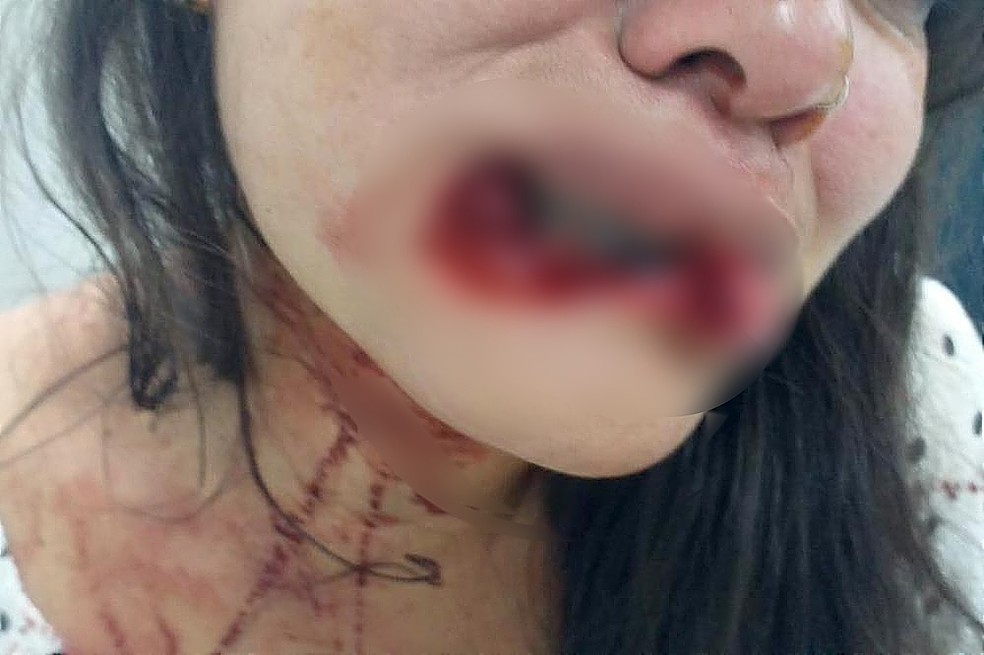 Mulher teve parte de lábio arrancado — Foto: Arquivo pessoal
