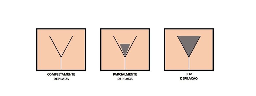 Featured image of post Depila o A Laser Virilha Cavada