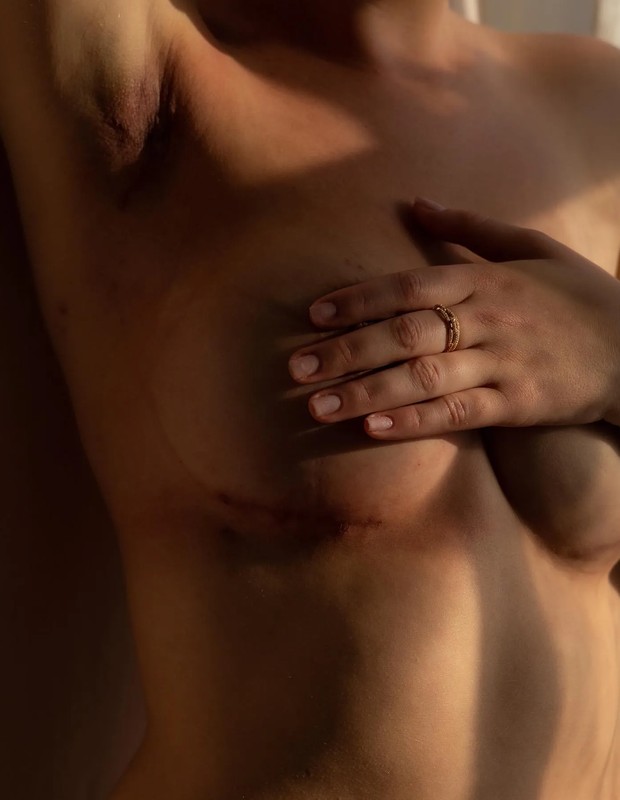 Miranda McKeon posa de lingerie após câncer e mastectomia dupla (Foto: Reprodução/Instagram)