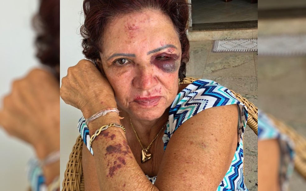 Ex-primeira dama de Itaberaí, Eleni Soares, de 71 anos, mostra marcas de agressão durante um assalto, em Goiás — Foto: Rita de Cássia Mendonça/ Arquivo pessoal