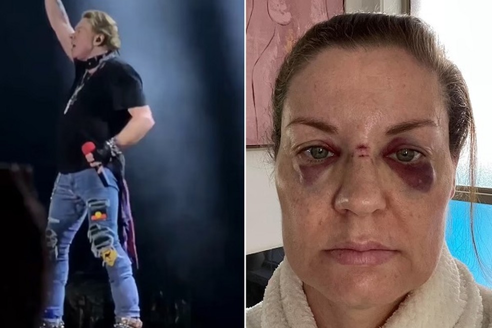  Rebecca Howe (à direita) ficou com o rosto machucado após ser atingida por microfone arremessado por Axl Rose  — Foto: Reprodução/Facebook