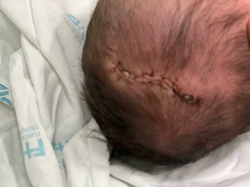 A pequena Olívia recebeu 11 pontos na cabeça após cair no chão durante parto em recepção de maternidade em BH — Foto: Arquivo pessoal 