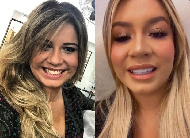 Após negar plásticas, Marília Mendonça confessa preenchimento labial; compare