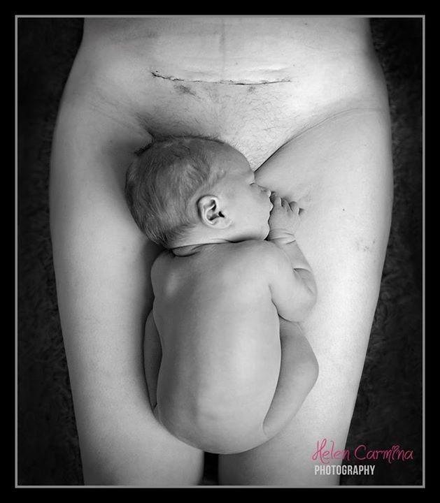 Bebê, mãe e a cicatriz da cesárea (Foto: Helen Carmina)