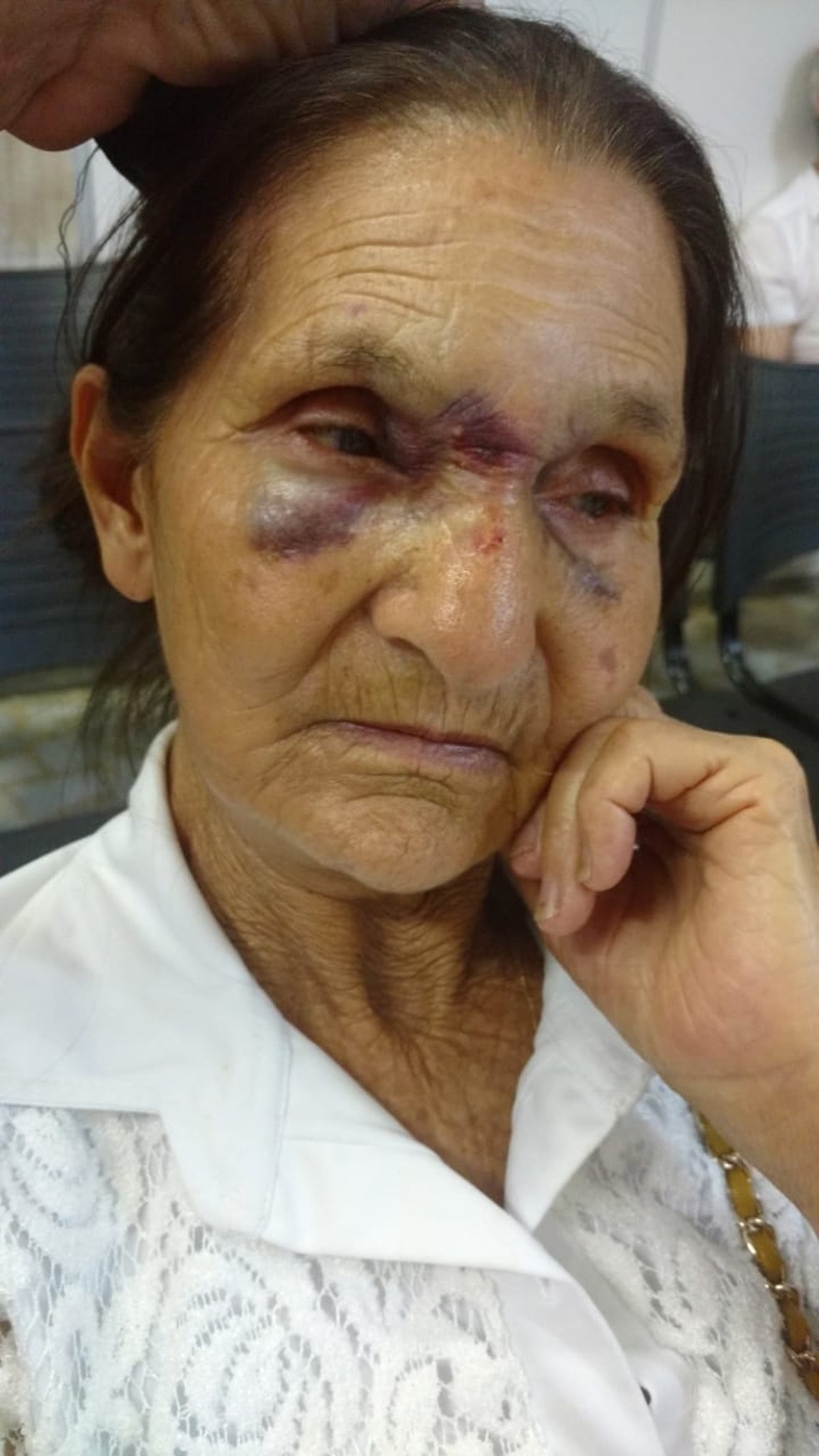 Idosa levou diversos socos e ficou com marcas no rosto — Foto: Arquivo Pessoal