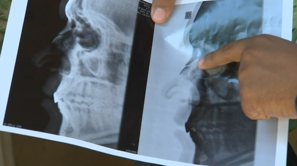 Raio X mostra paciente com nariz quebrado (Foto: ReproduÃ§Ã£o/TV TEM)