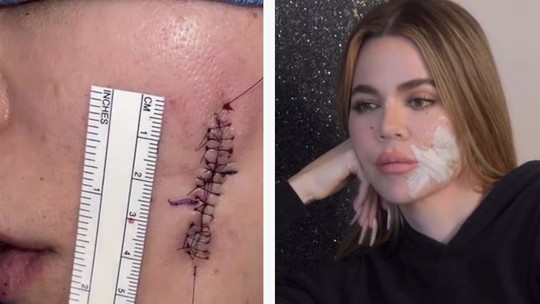 Khloe Kardashian mostra cicatriz de cirurgia de retirada de melanoma 