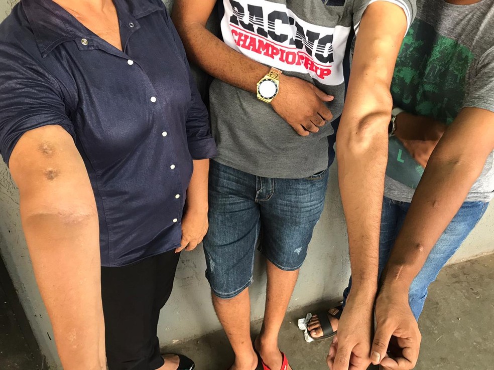 Pacientes do Centro de Tranplantes de Rondônia mostram braços com fístula arteriovenosa. Marcas são feitas durante a filtragem do sangue na hemodiálise.  — Foto: Ana Kézia Gomes/G1