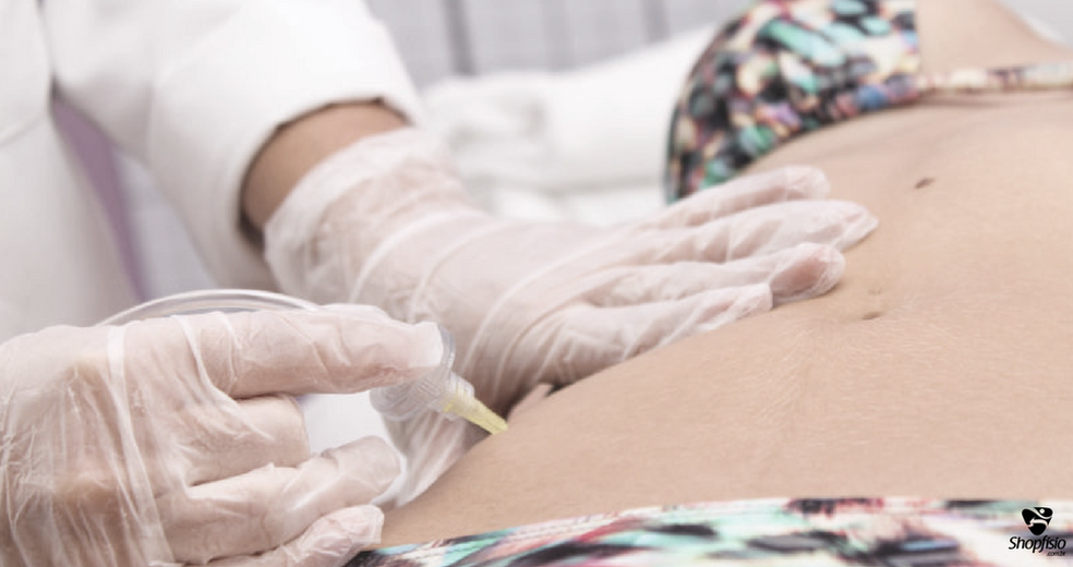 Carboxiterapia Combate Estrias De Maneira Eficiente Atraves Do Gas Carbonico Especial Publicitario Shopfisio G1