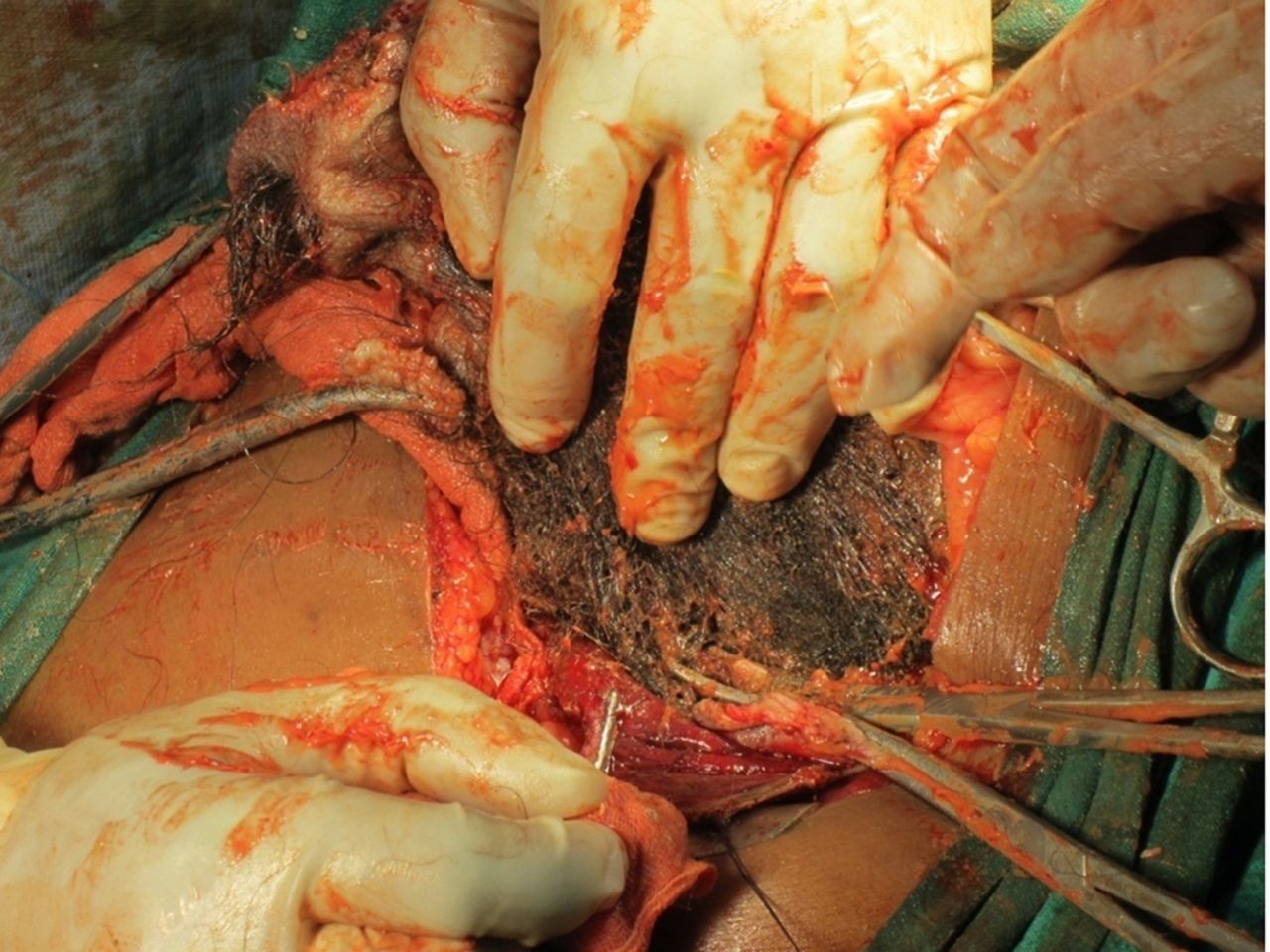 Massa de 30×16×10 centímetros estava sob o fígado e foi retirada em cirurgia (Foto: BMJ Case Reports 2019)