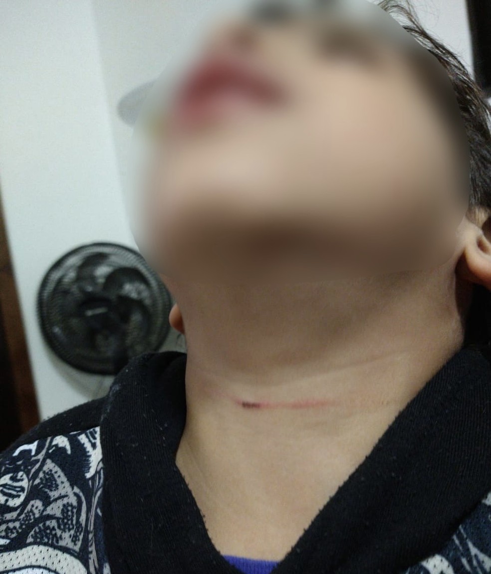 Menino mostra machucado no pescoço após quase uma semana — Foto: Arquivo pessoal