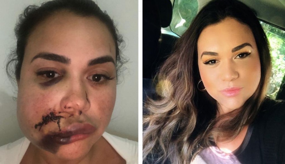 Mulher diz ter tomado 40 pontos no rosto após ser agredida em restaurante de São Paulo — Foto: Reprodução/Redes sociais