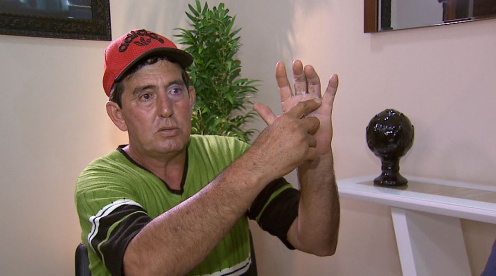 O tratorista Daniel Mendes de Almeida reclama de erro médico após ter dedo errado operado em Barretos, SP — Foto: Chico Escolano/EPTV