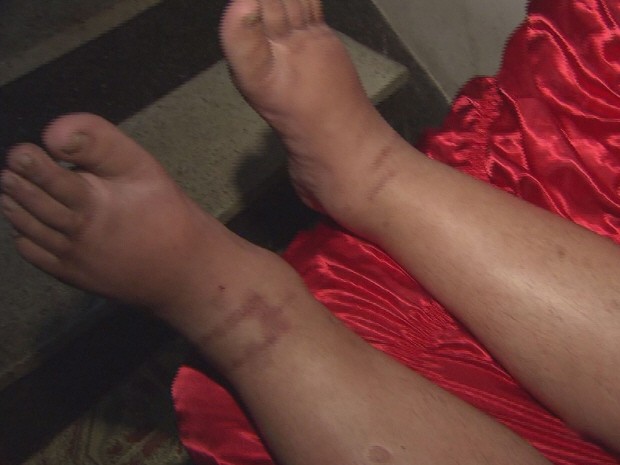 Após cirurgia nas pernas paciente corre o risco de ficar com trombose (Foto: Reprodução/TV Tribuna)