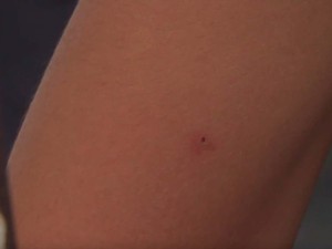 Marca da seringa no braço da adolescente que foi vítima de ataque na Bahia  (Foto: Imagem/Tv Bahia)