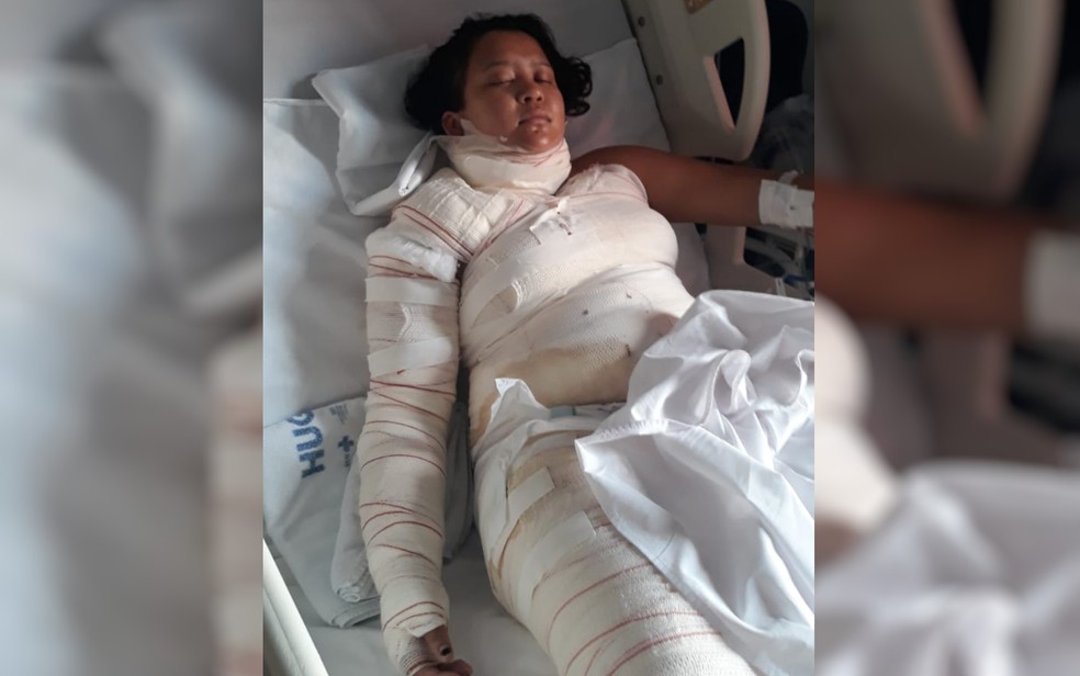 Wiviane Lima sofre queimaduras ao cozinhar com álcool por falta de gás — Foto: Divulgação/Arquivo Pessoal