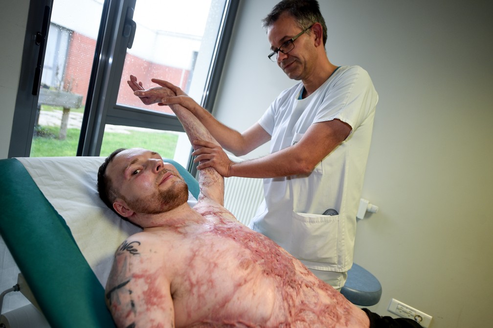  Franck sofreu queimaduras em mais de 95% de seu corpo e foi salvo por um transplante de pele de seu irmão gêmeo (Foto: Francoi Lo Presti / AFP)